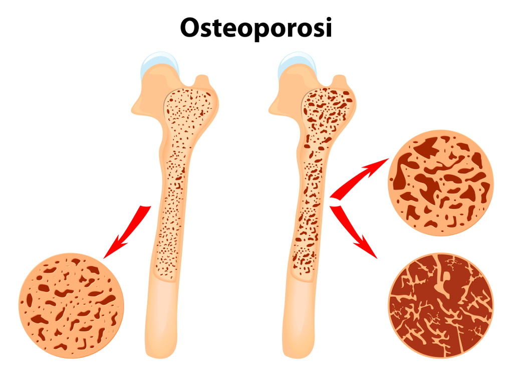 controllo-osteoporosi-parafarmacia